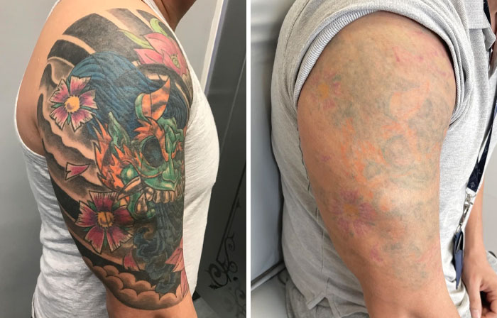 Comparación antes y después de eliminación de tatuaje en brazo con diseño colorido y resultado casi sin pigmento visible.