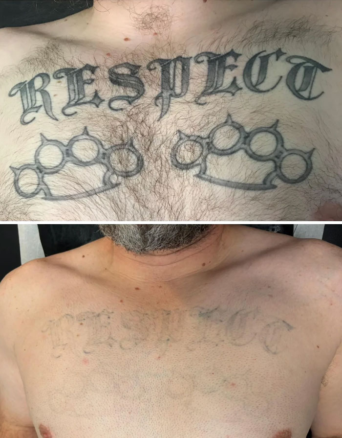 Tatuaje de respeto y knuckles dorados en pecho antes y después de la eliminación de tatuajes mostrando gran cambio.