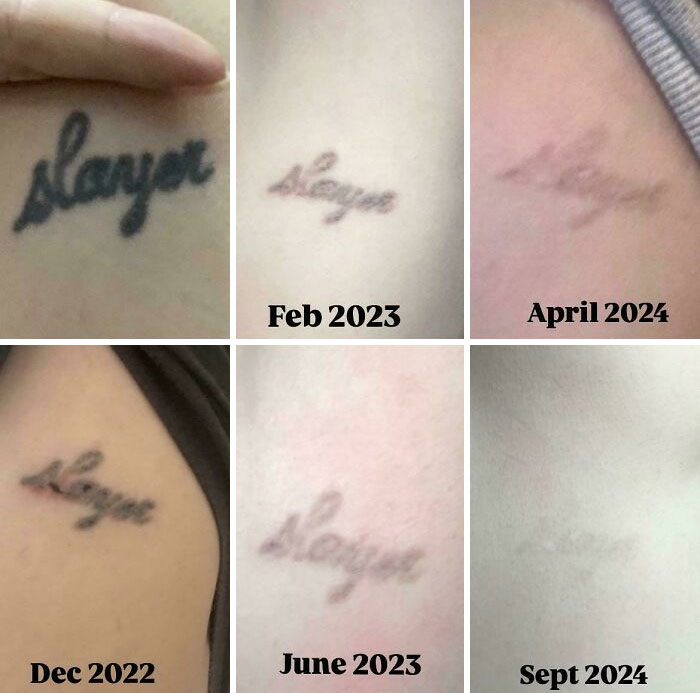 Serie de fotos mostrando la progresión de eliminación de tatuajes antes y después con resultados visibles en el tiempo.