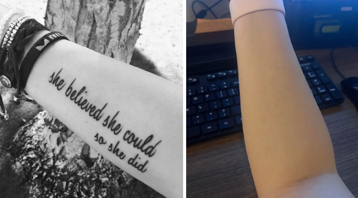 Brazo antes y después de la eliminación de tatuaje mostrando los resultados del cambio de vida tras el proceso.