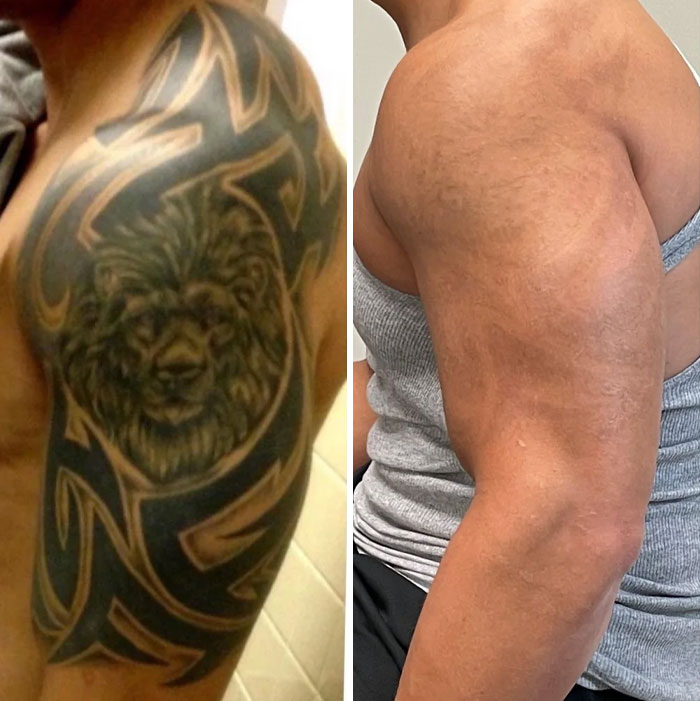 Brazo masculino mostrando fotos antes y después de la eliminación de tatuajes con cambios visibles en la piel.