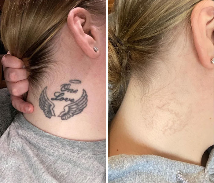 Comparación antes y después de la eliminación de tatuaje en el cuello mostrando resultados visibles y piel casi limpia.