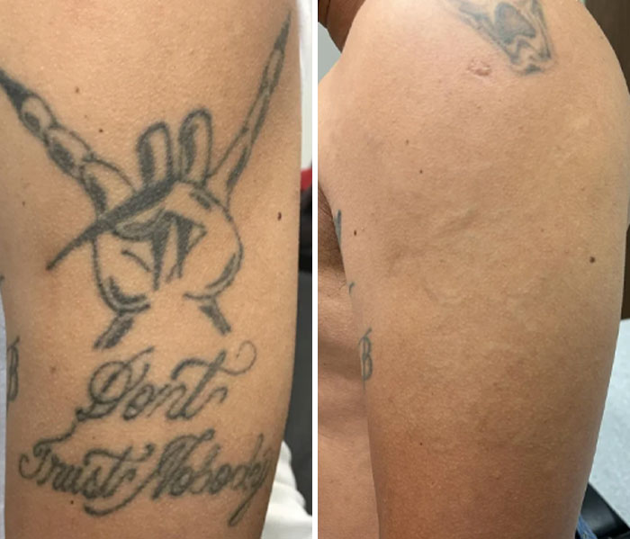 Brazo mostrando antes y después de la eliminación de tatuaje, resaltando el cambio de piel limpia y sin tinta.