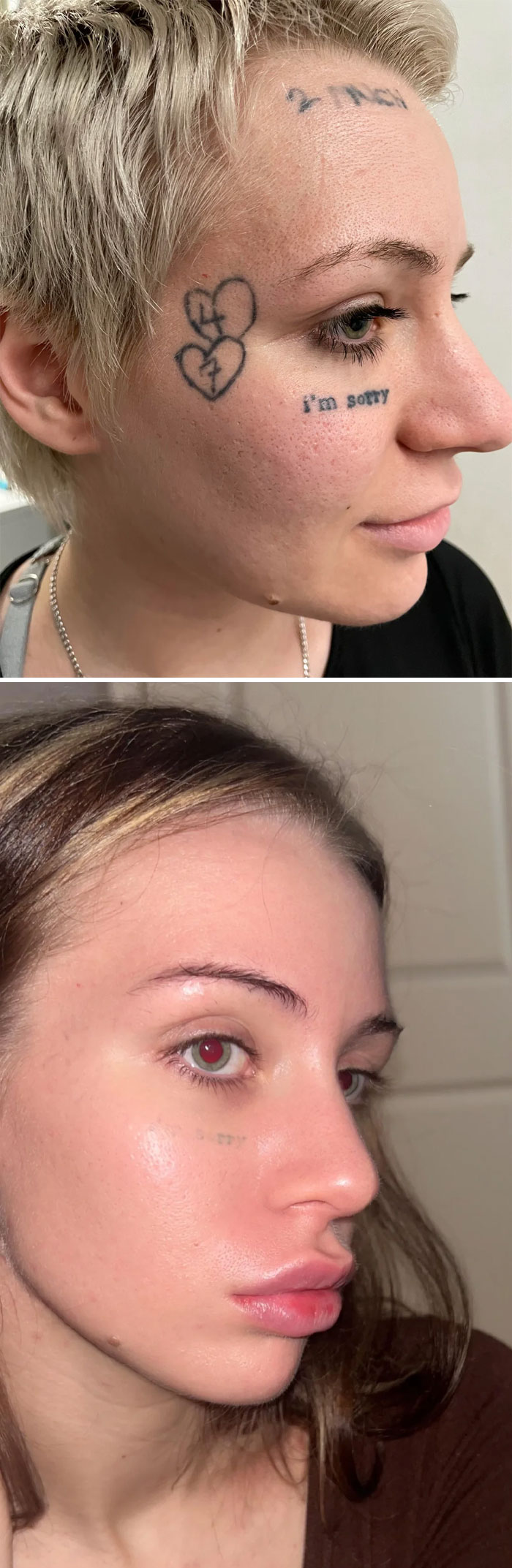 Antes y después de la eliminación de tatuajes faciales con cambio visible en la piel y reducción de tinta en el rostro.