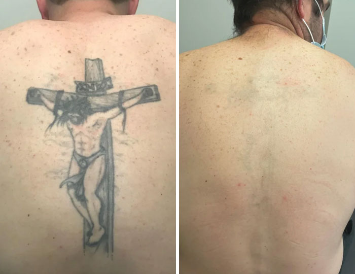 Hombre mostrando el antes y después de la eliminación de tatuajes en la espalda, con resultados visibles.