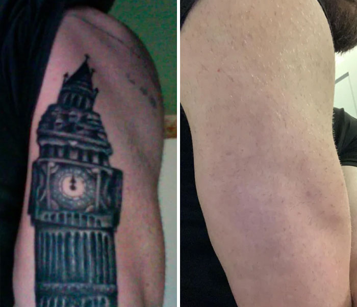 Brazo de hombre mostrando fotos antes y después de la eliminación de tatuajes con resultados visibles y piel limpia.