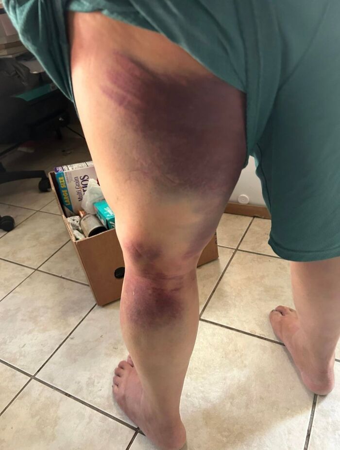 Pierna con moretones graves, ejemplo de publicaciones médicas bizarras y desconcertantes compartidas en línea.