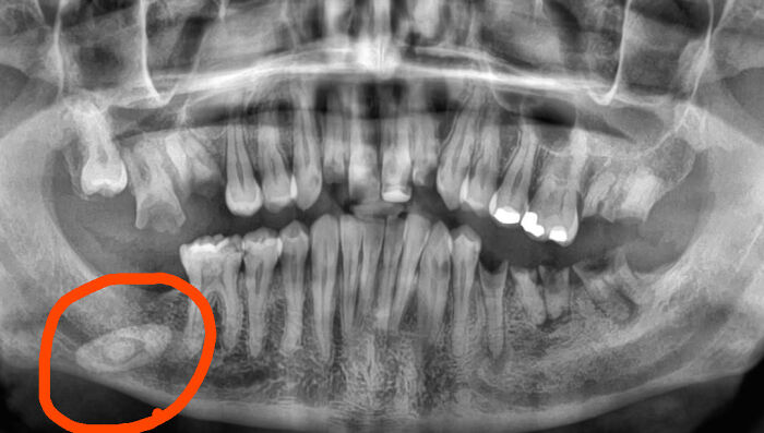 Radiografía dental con objeto extraño marcado, ilustrando experiencias extrañas sin explicación clara en casos reales.