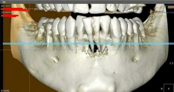 Radiografía 3D mostrando huesos faciales y dientes dañados, ilustrando que siempre puede empeorar visualmente.