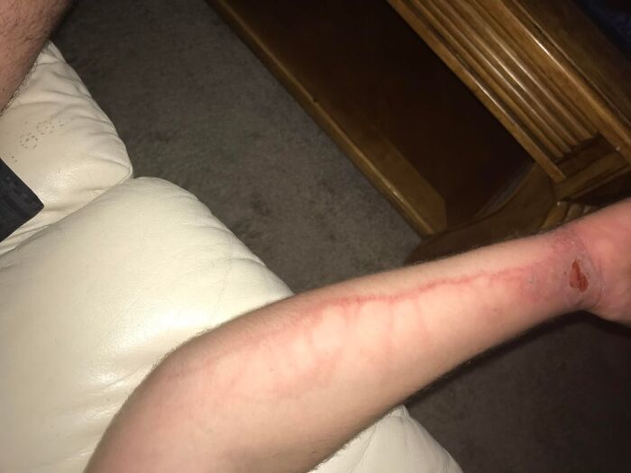 Brazo con marcas extrañas y heridas leves mostrando publicaciones médicas inquietantes y fuera de lo común compartidas en línea.