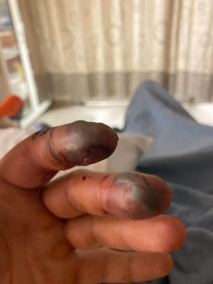 Dedos con necrosis y decoloración, ejemplo de contenido médico extraño y perturbador compartido en línea.