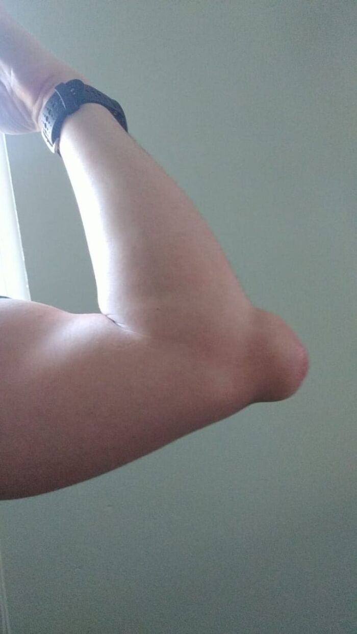 Brazo con deformidad visible en codo en imagen relacionada con publicaciones médicas extrañas y perturbadoras compartidas en línea.