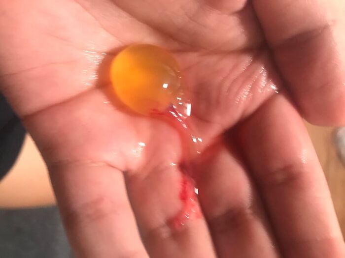 Mano sosteniendo objeto médico extraño y desconcertante con líquido amarillo y sangre, imagen inquietante y poco común en medicina.