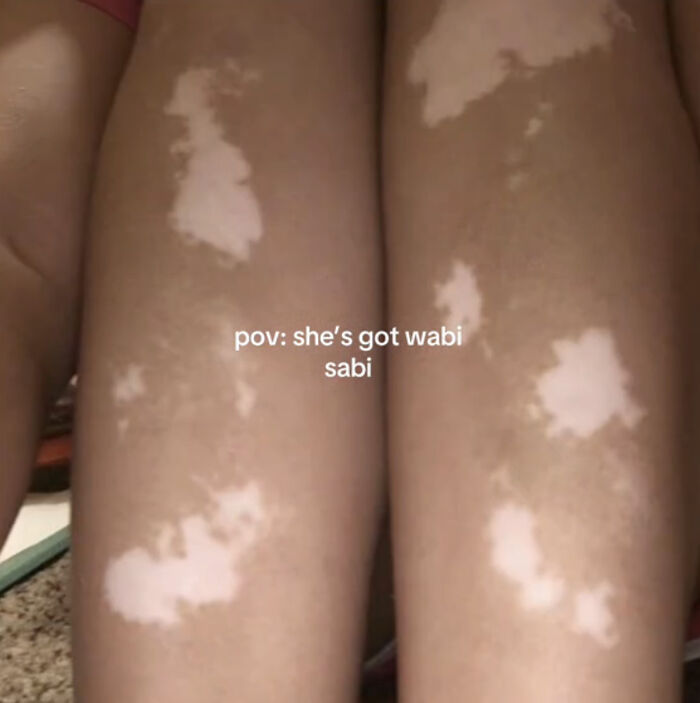 Piernas con vitiligo mostrando la belleza única y la celebración de lo que hace a las personas diferentes.
