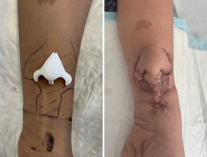 Brazo con prótesis quirúrgica nasal impresa en 3D antes y después de la cirugía, fotos médicas fascinantes y sorprendentes.