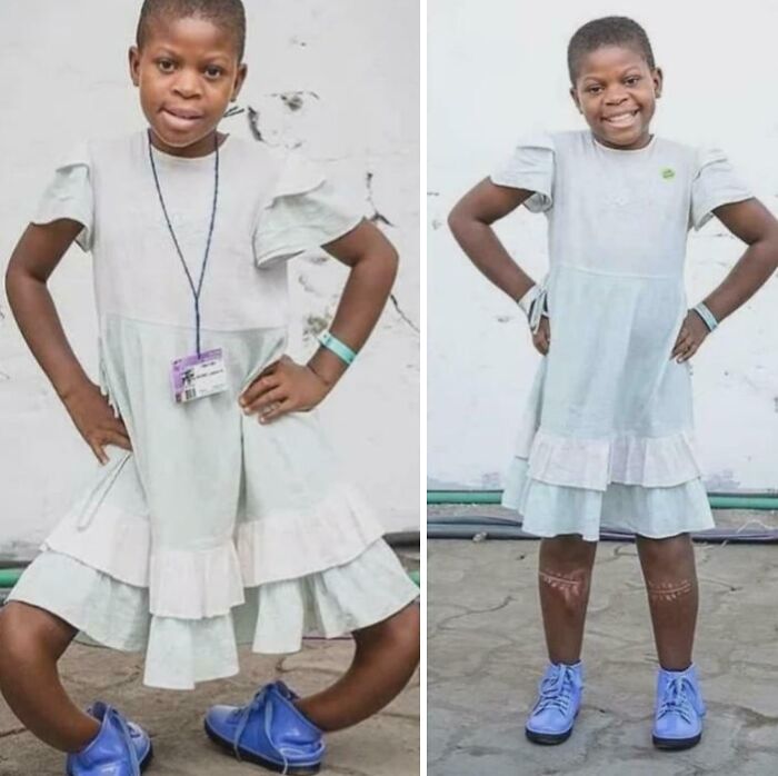 Niña sonriendo con vestido blanco y zapatos azules mostrando cicatrices médicas en piernas, foto médica fascinante y desconcertante.