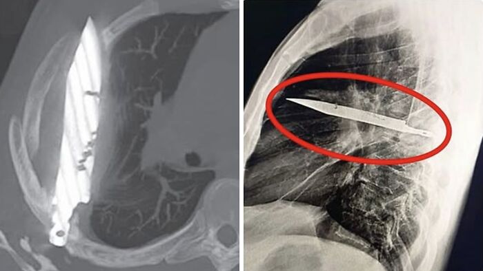 Radiografías médicas fascinantes que muestran objetos extraños incrustados en el cuerpo humano, imágenes médicas inquietantes.
