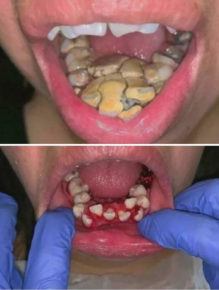 Boca con acumulación severa de sarro dental y limpieza odontológica sangrante, foto médica fascinante y inquietante.
