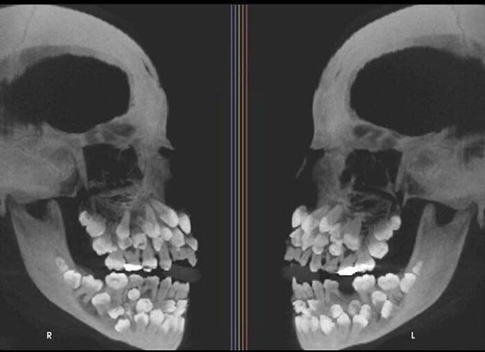 Radiografía de cráneo mostrando múltiples dientes en desarrollo, imagen impactante para personas con un peor día.